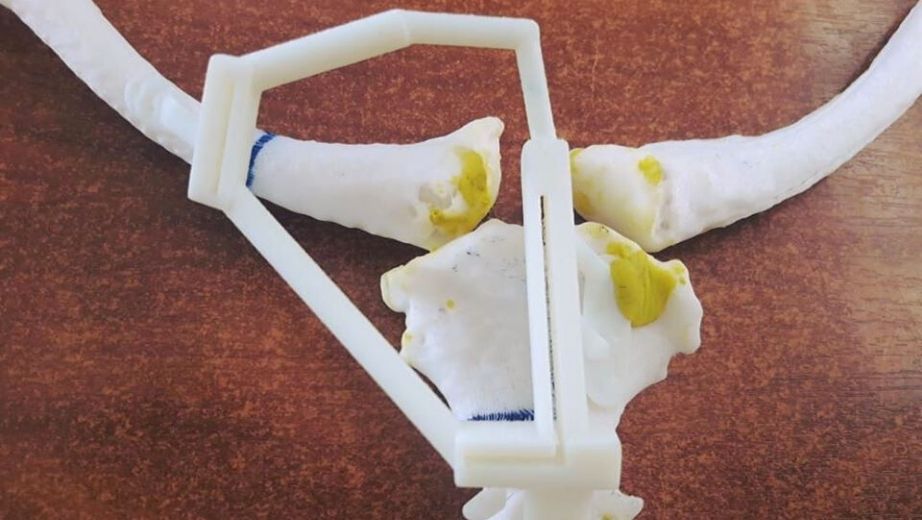 Prótesis ósea que serán utilizadas en la cirugía de un paciente adulto