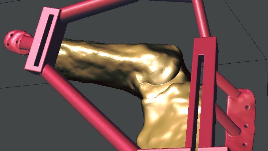 Modelado en 3D de la prótesis ósea que serán utilizadas en la cirugía de un paciente adulto